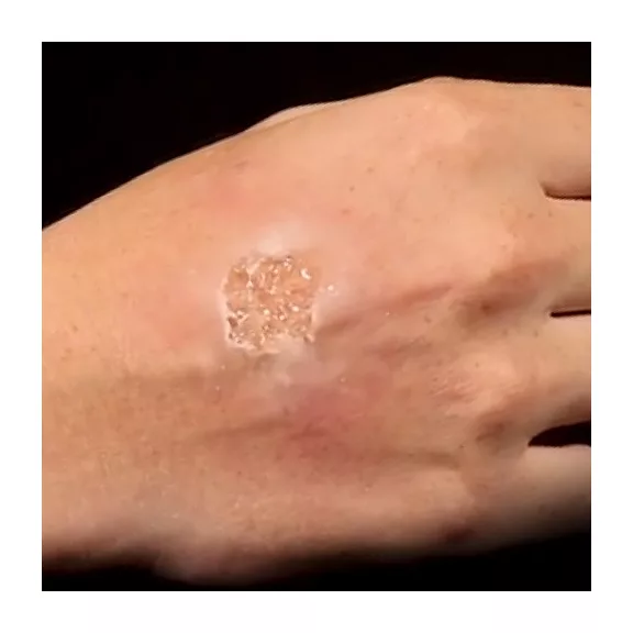Grimas Blister Gel smink, hólyagok szimulálására